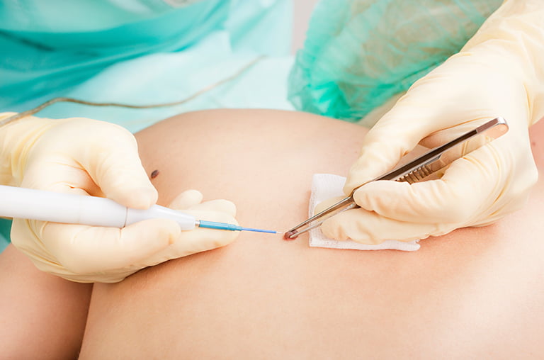 Dermatologist removes mole electrocoagulation method.