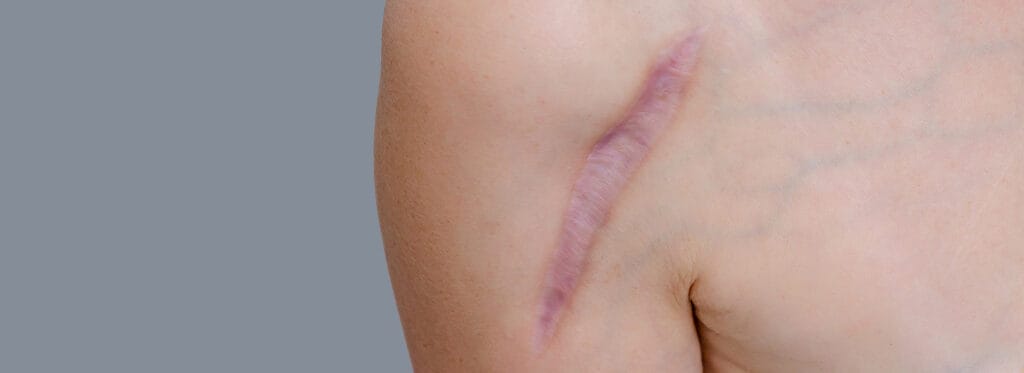 USG w kosmetologii i terapii blizn – jak rozszerzyć ofertę diagnostyczną dla kosmetologów