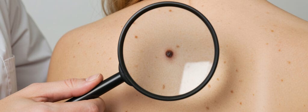 Usuwanie pieprzyków Szczecin – bezpiecznie i profesjonalnie u chirurga onkologa