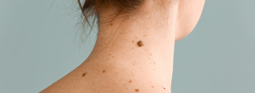 Usuwanie pieprzyków Szczecin – chirurg onkologiczny specjalizujący się w nowotworach skóry